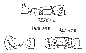 下肢の下部、足首の骨折